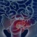 SUS adota novo exame para rastrear câncer colorretal na população